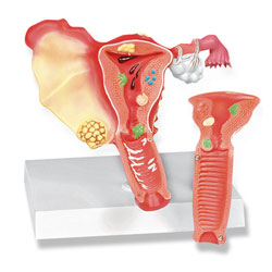 Pathological Model of the Female Reproductive System