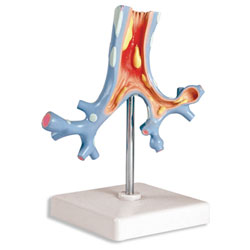 Pathological Model of Bronchi