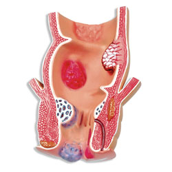 Pathological Model of the Rectum