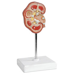 Pathological Model of the Renal Calculus 