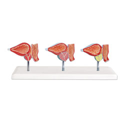 Normal and Diseased Prostate Gland Model 