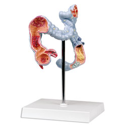 Colon Diseases Model 